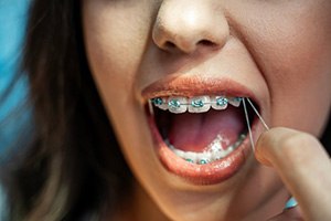 Lady pulls the orthodontic elastics on her braces