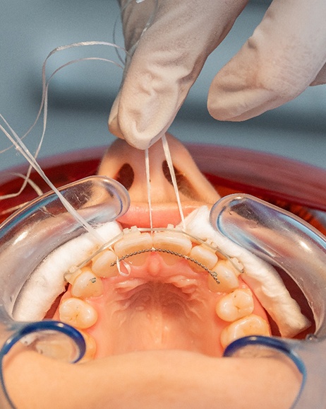 Closeup of a fixed retainer