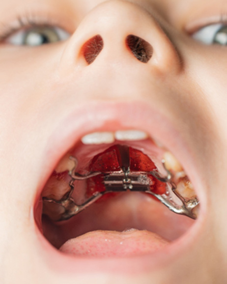 Palatal expander inside patient’s mouth