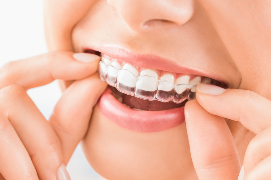 Woman fitting clear retainer