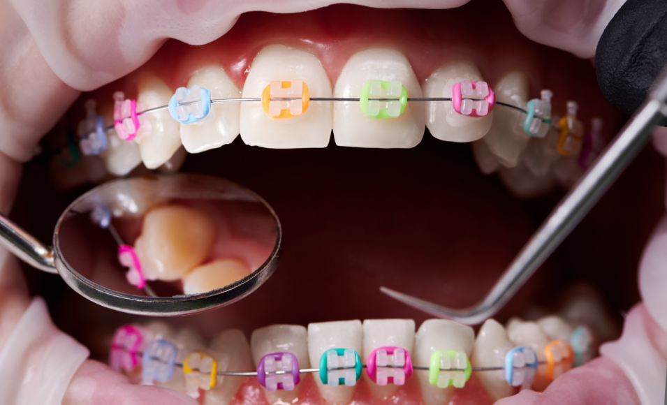 Close up of rainbow braces